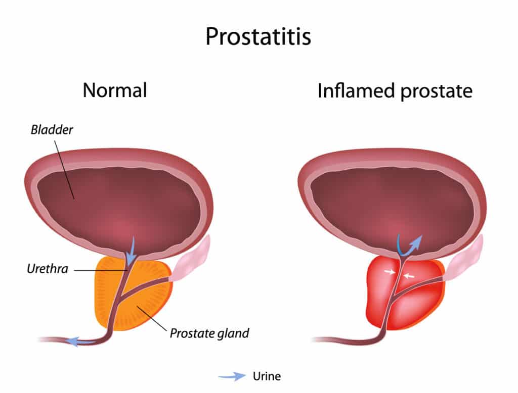 About The Prostate Gland Prostatitis Care Specialists 